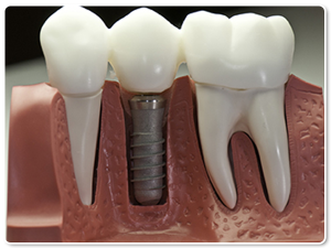 Dental-implant1